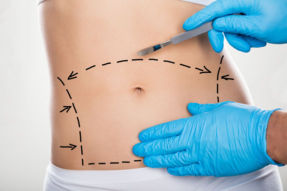 Abdominoplastik Hessen